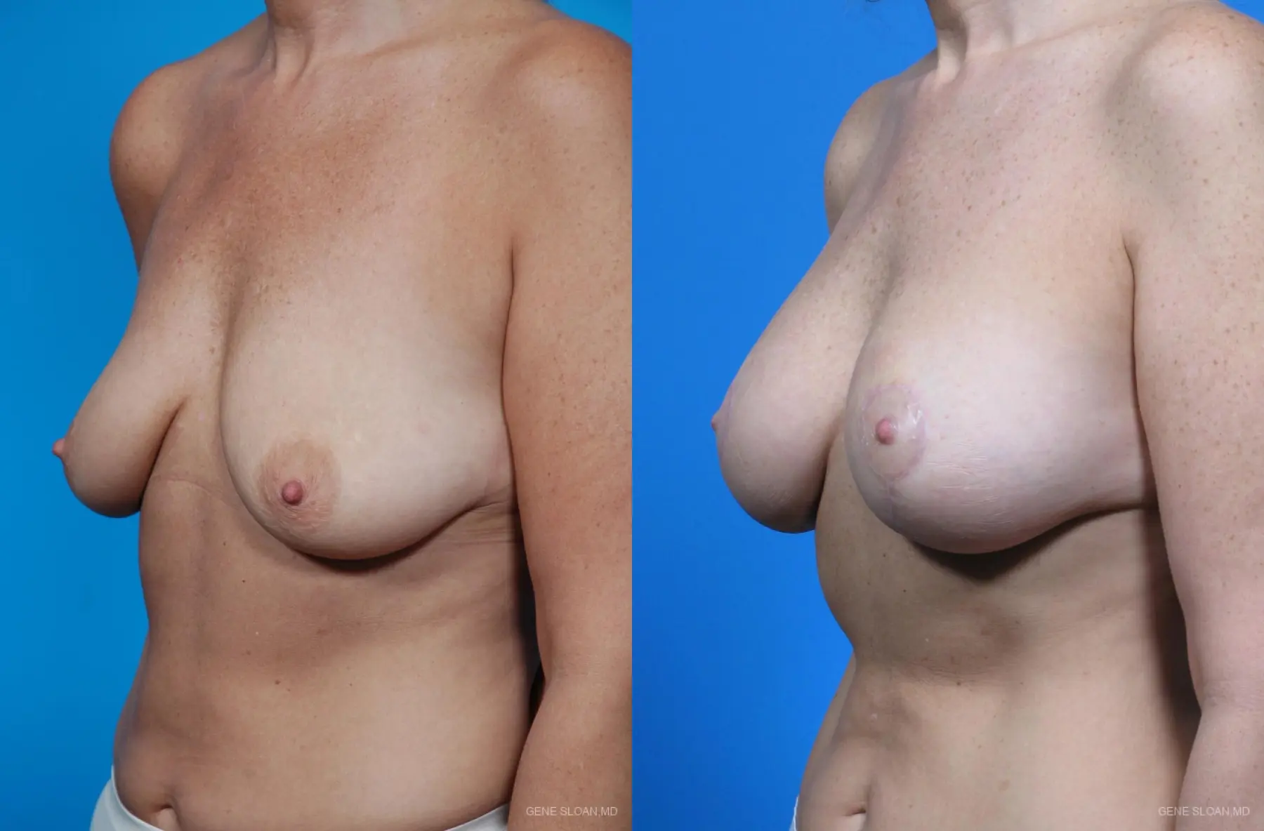 Breast Augmentation With Lift: Patient 5 - Before and After 2