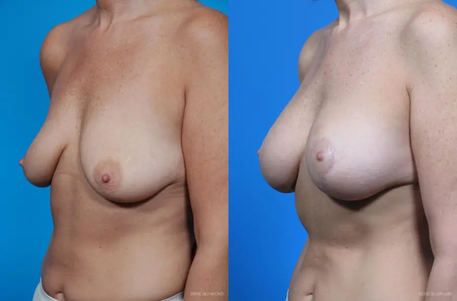 Breast Augmentation With Lift: Patient 5 - Before and After 2