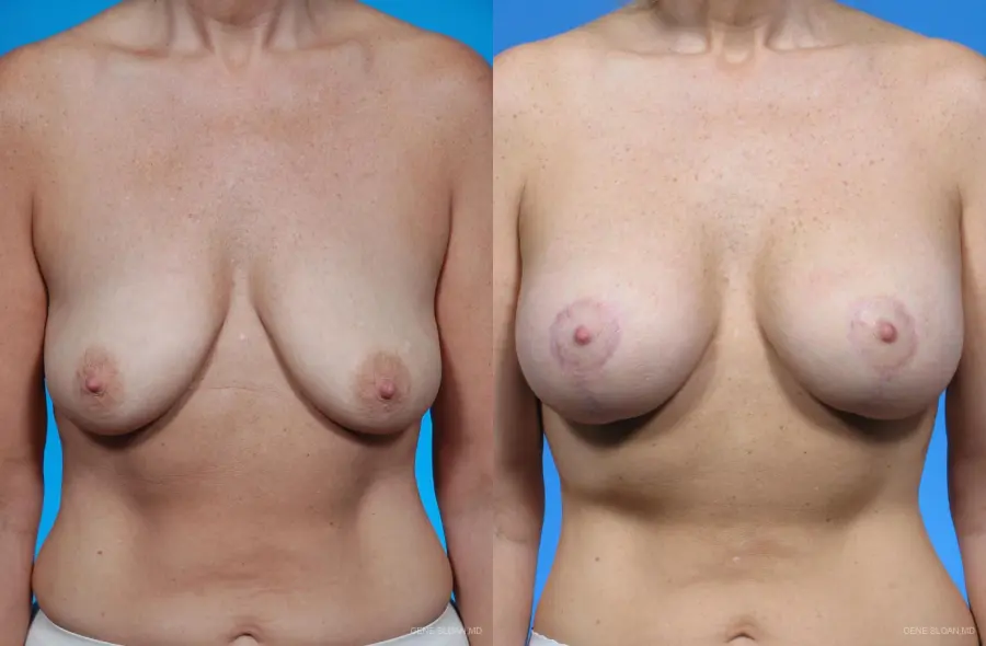 Breast Augmentation With Lift: Patient 5 - Before and After 1