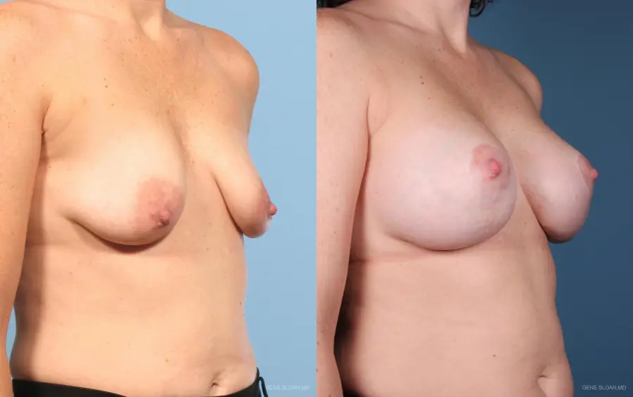 Breast Augmentation With Lift: Patient 6 - Before and After 2