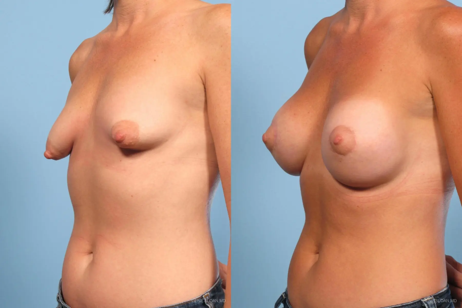 Breast Augmentation With Lift: Patient 4 - Before and After 2
