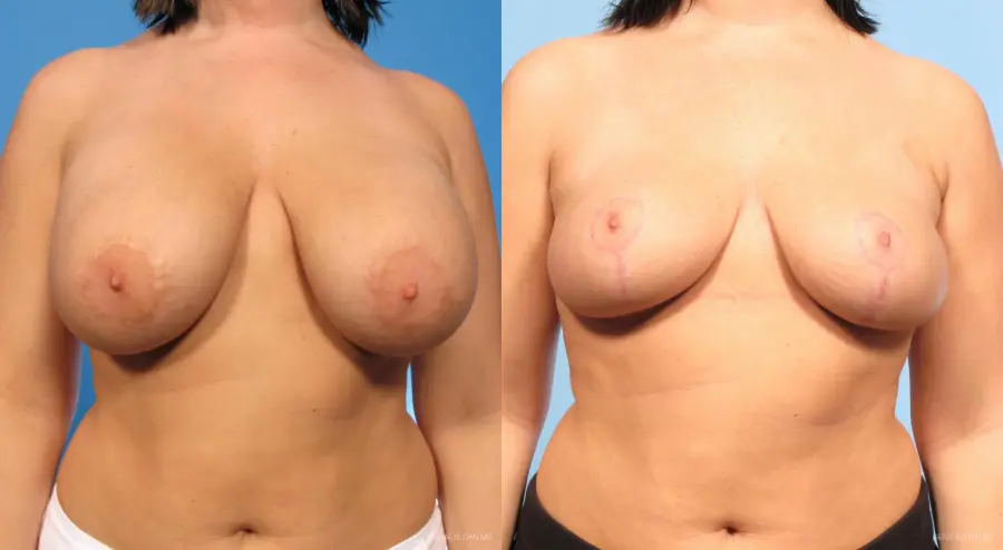 Breast Implant Revised: Patient 1 - Before and After 1