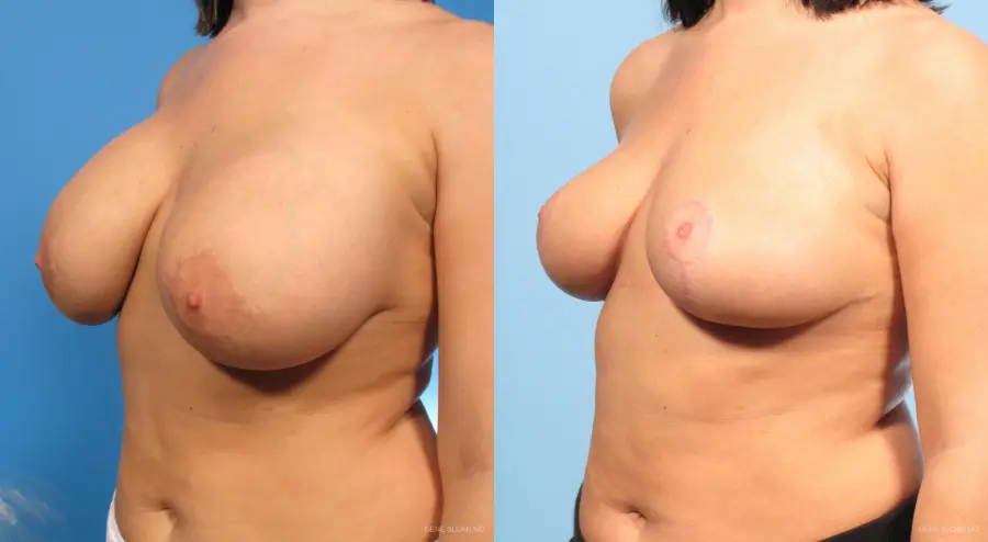 Breast Implant Revised: Patient 1 - Before and After 2