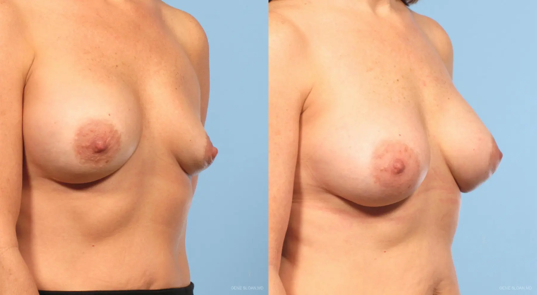 Breast Implant Revised: Patient 2 - Before and After 2