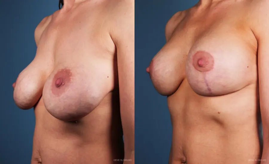 Breast Implant Revised: Patient 3 - Before and After 2