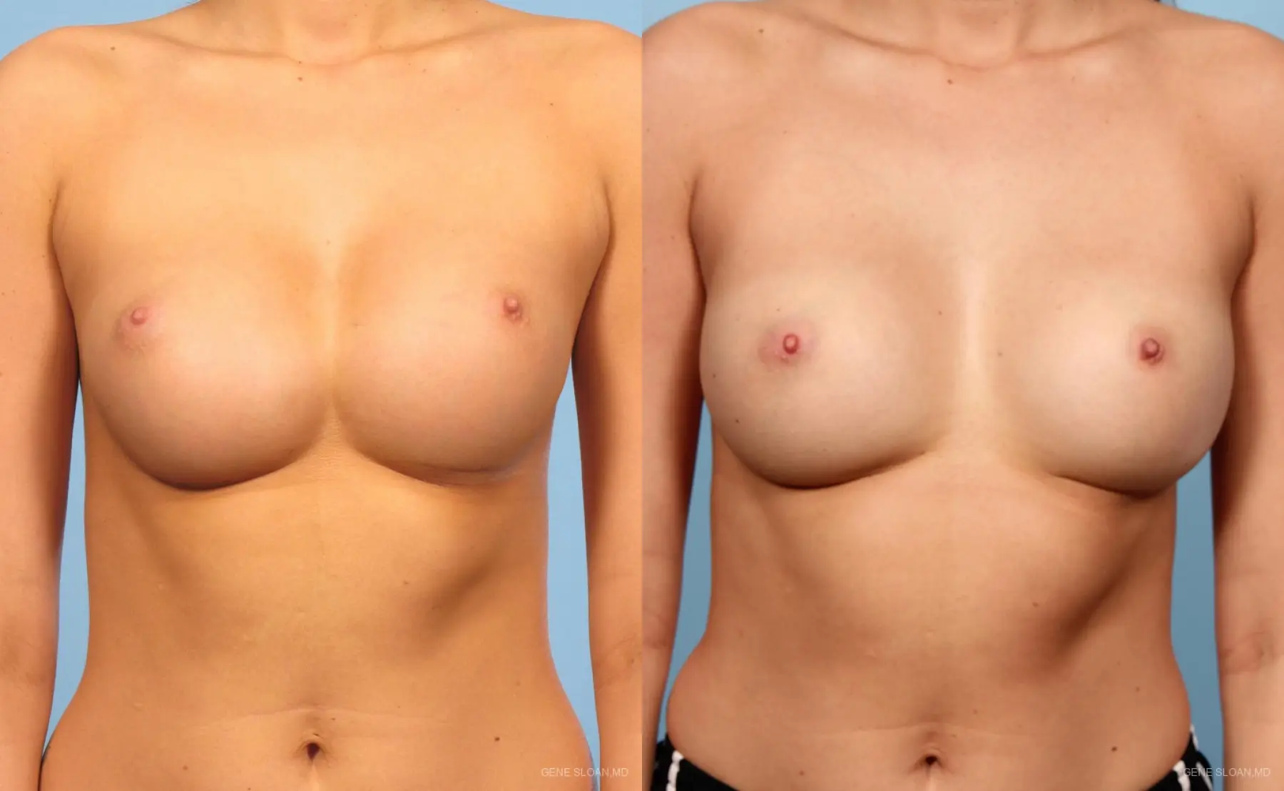 Breast Implant Revised: Patient 6 - Before and After 1