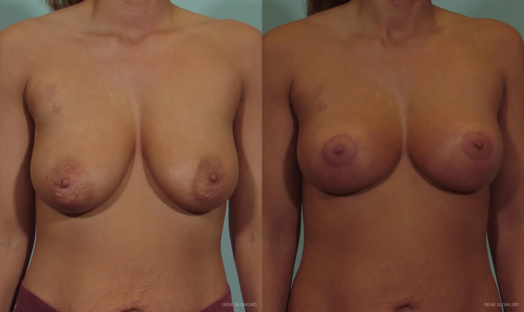 Breast Lift: Patient 5 - Before and After 1