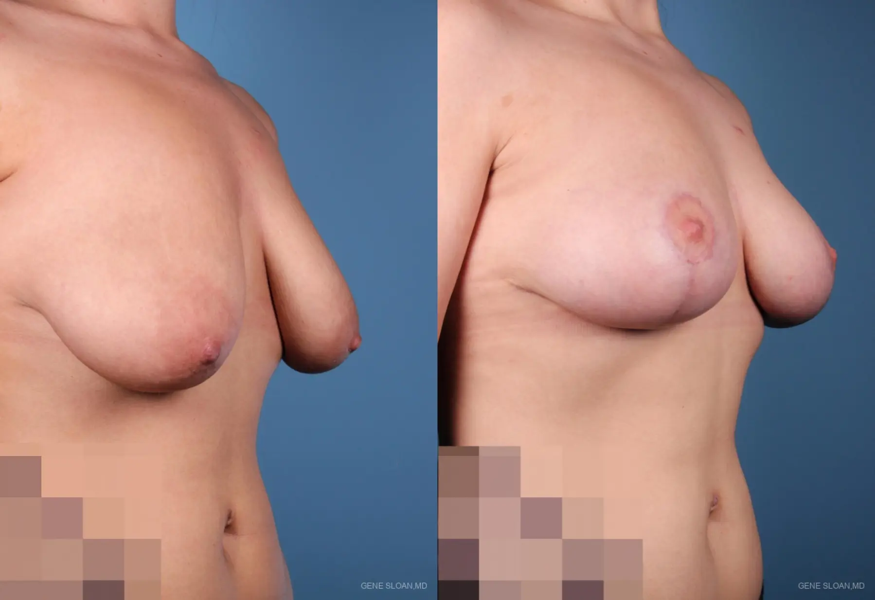Breast Lift: Patient 1 - Before and After 2