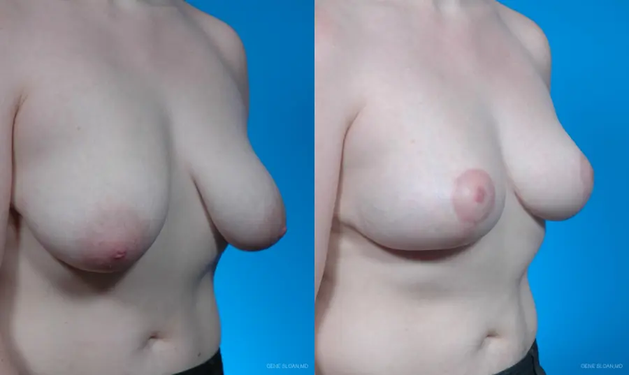 Breast Lift: Patient 3 - Before and After 2