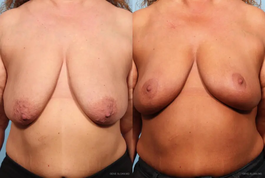Breast Lift: Patient 2 - Before and After 1