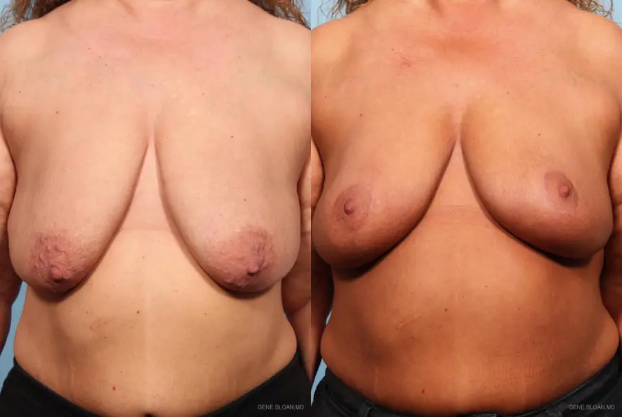 Breast Lift: Patient 2 - Before and After