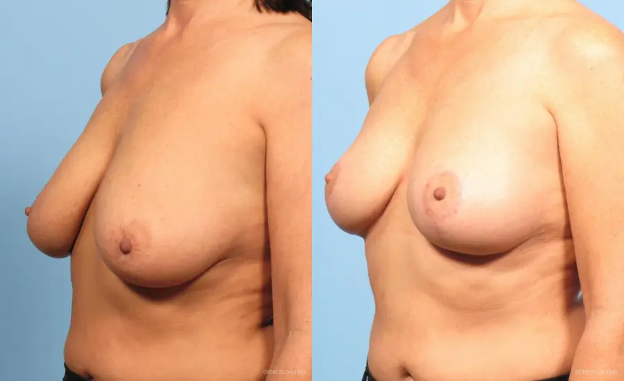 Breast Lift: Patient 4 - Before and After 2