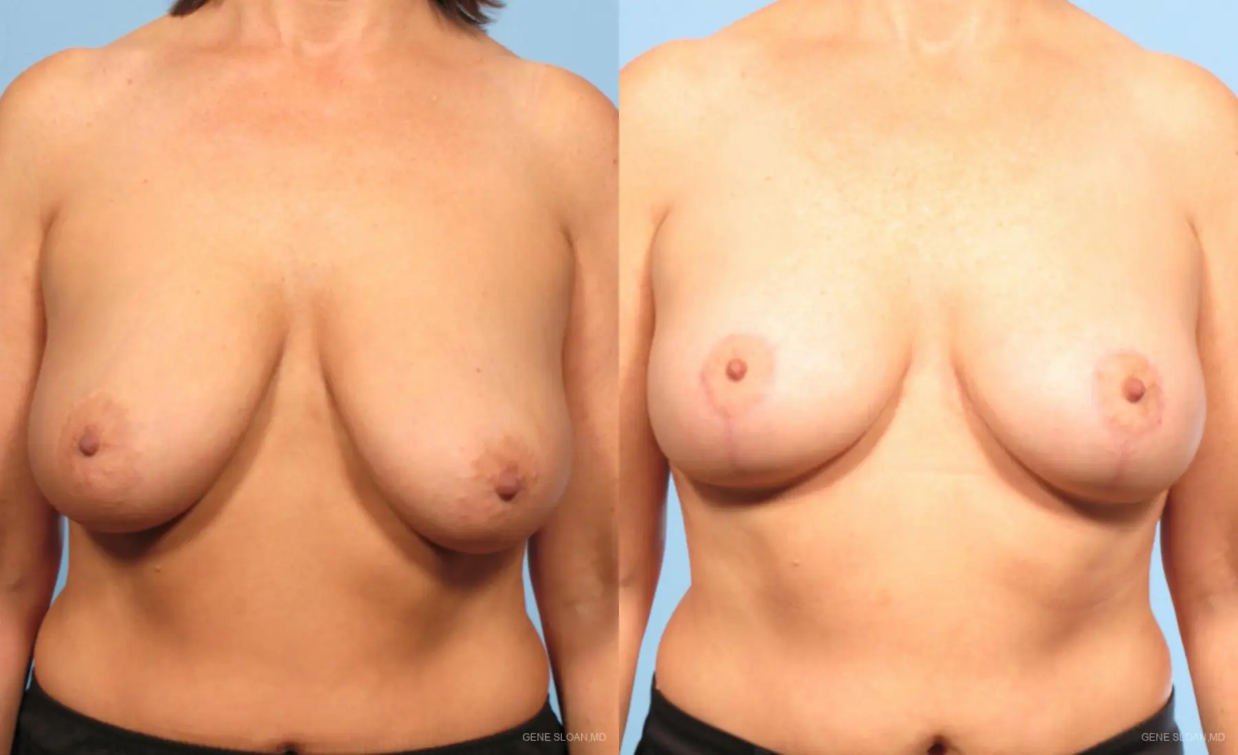 Breast Lift: Patient 4 - Before and After 1