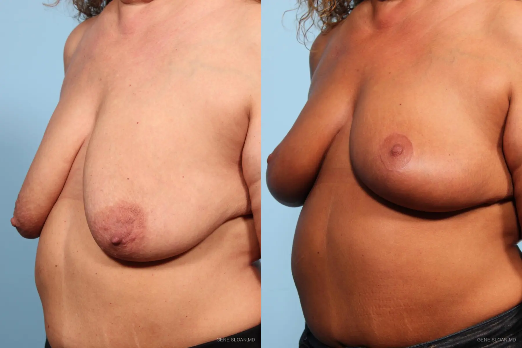 Breast Lift: Patient 2 - Before and After 2