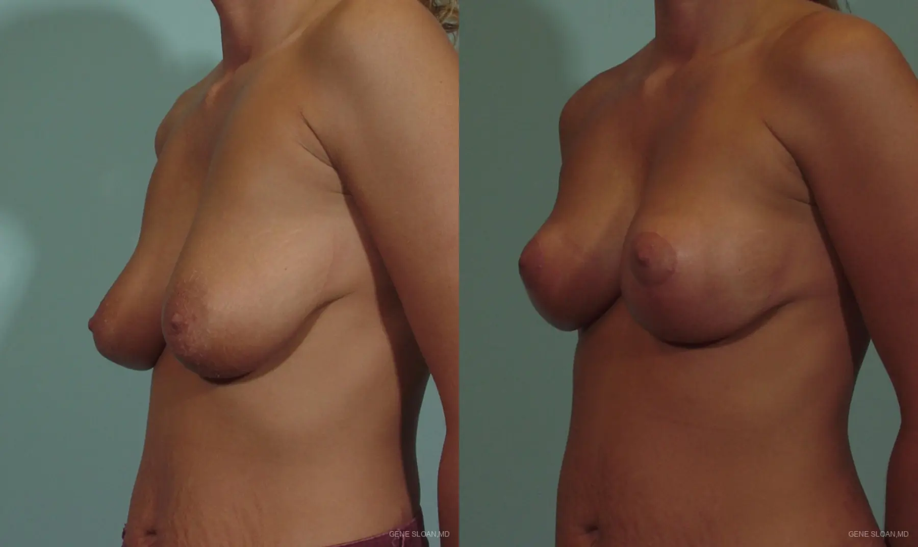 Breast Lift: Patient 5 - Before and After 2