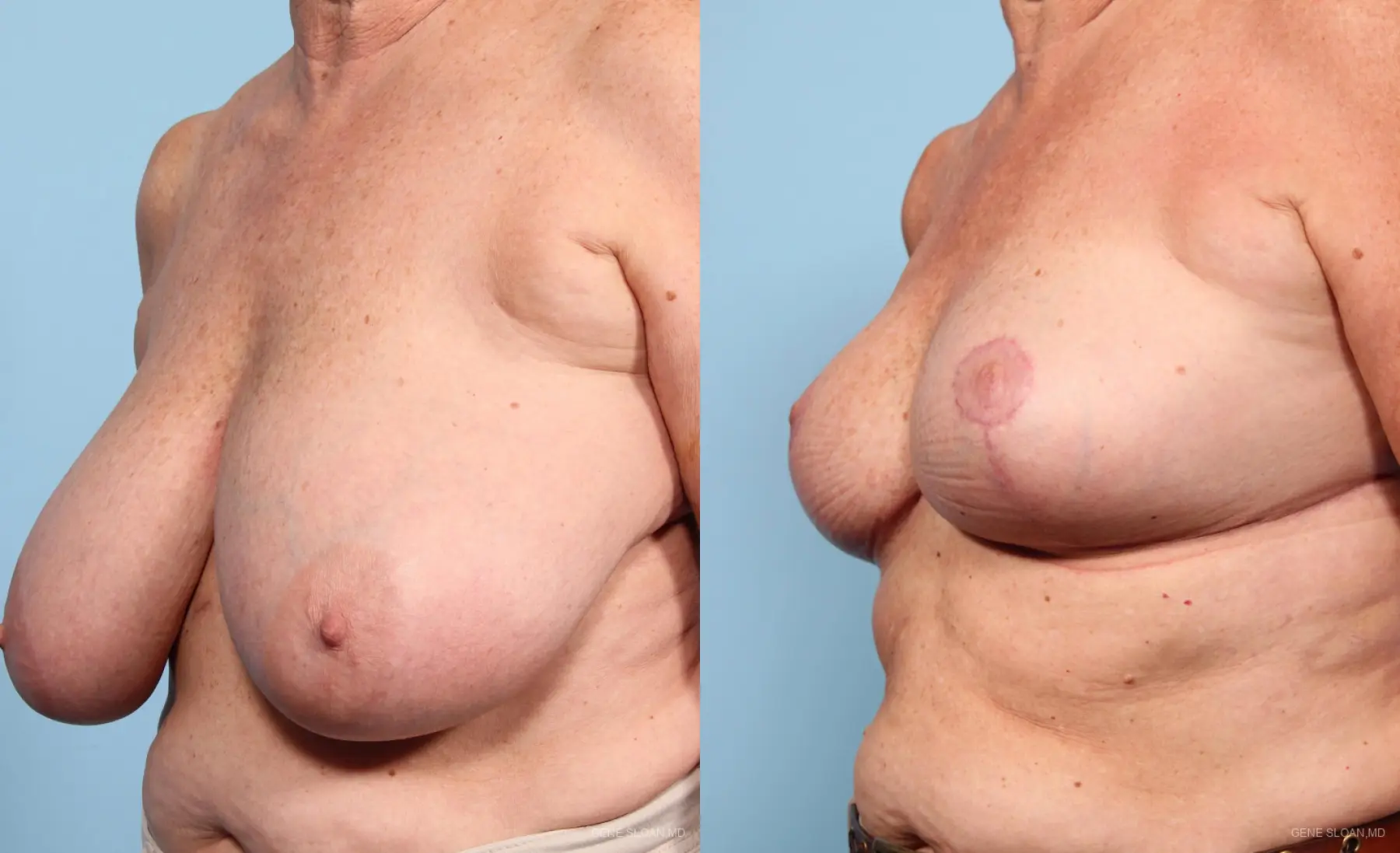 Breast Reduction: Patient 1 - Before and After 2