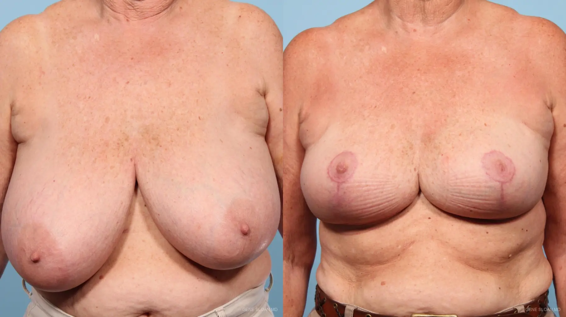 Breast Reduction: Patient 1 - Before and After 1