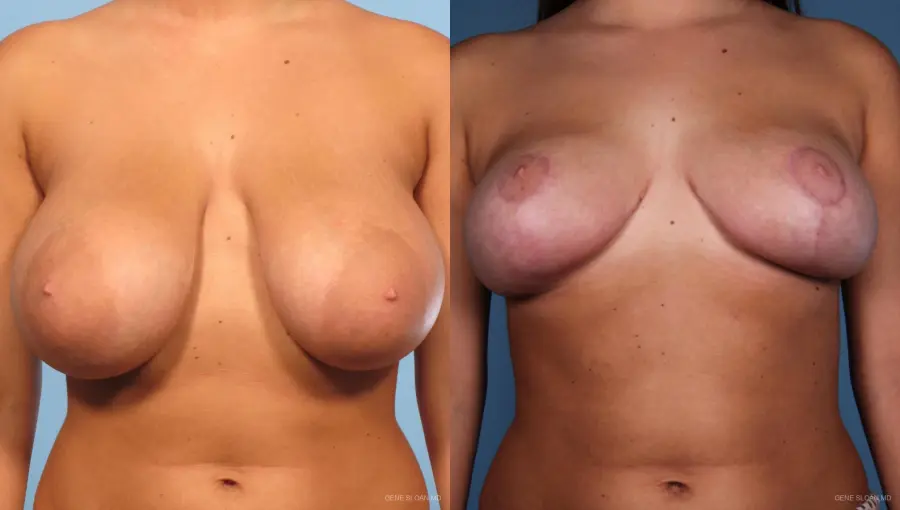 Breast Reduction: Patient 2 - Before and After 1