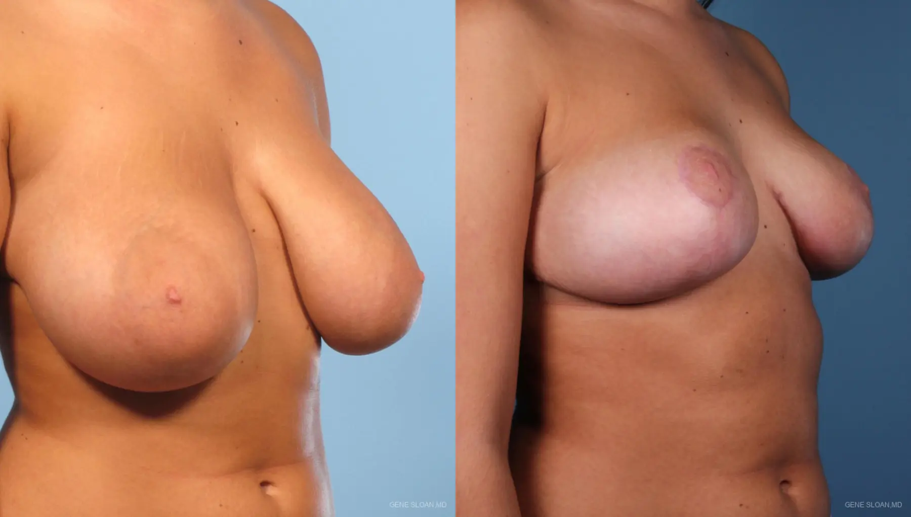 Breast Reduction: Patient 2 - Before and After 2