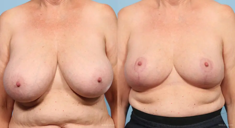 Breast Reduction: Patient 3 - Before and After  