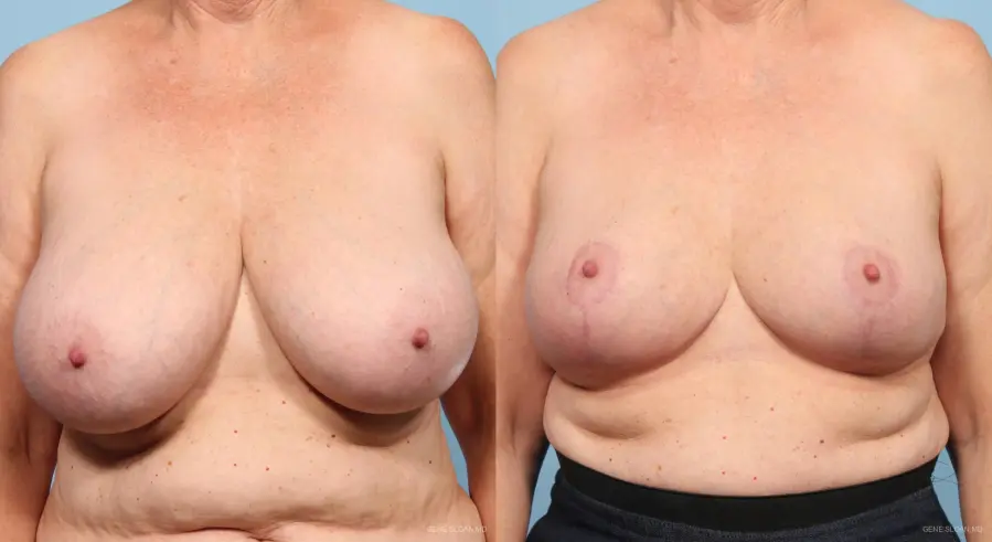 Breast Reduction: Patient 3 - Before and After 1
