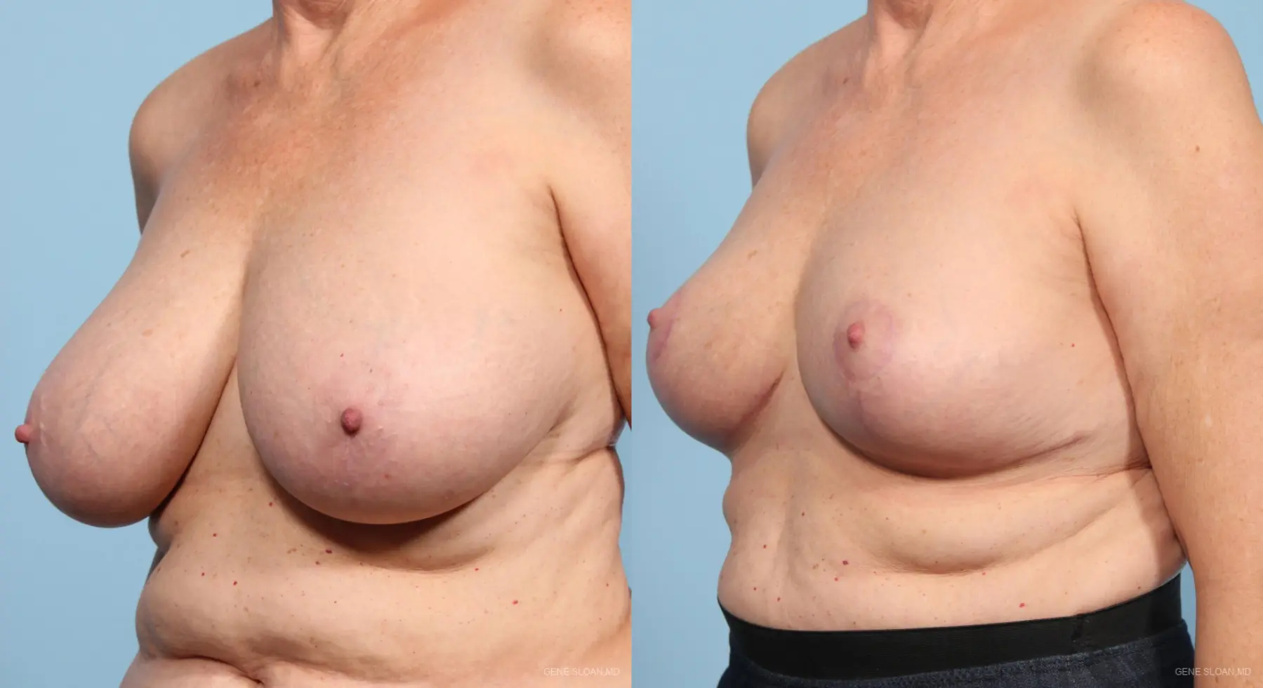 Breast Reduction: Patient 3 - Before and After 2