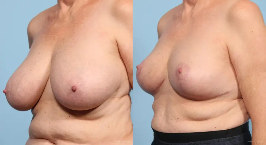 Breast Reduction: Patient 3 - Before and After 2