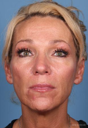Fat Transfer - Face: Patient 1 - Before Image 1