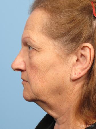 Facelift: Patient 6 - Before and After Image 2