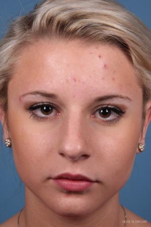 Rhinoplasty: Patient 8 - Before Image 1