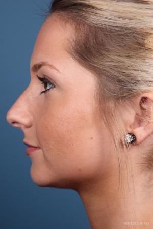 Rhinoplasty: Patient 7 - Before and After Image 2