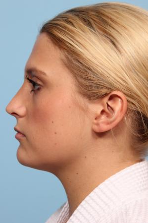 Rhinoplasty: Patient 6 - After Image 2