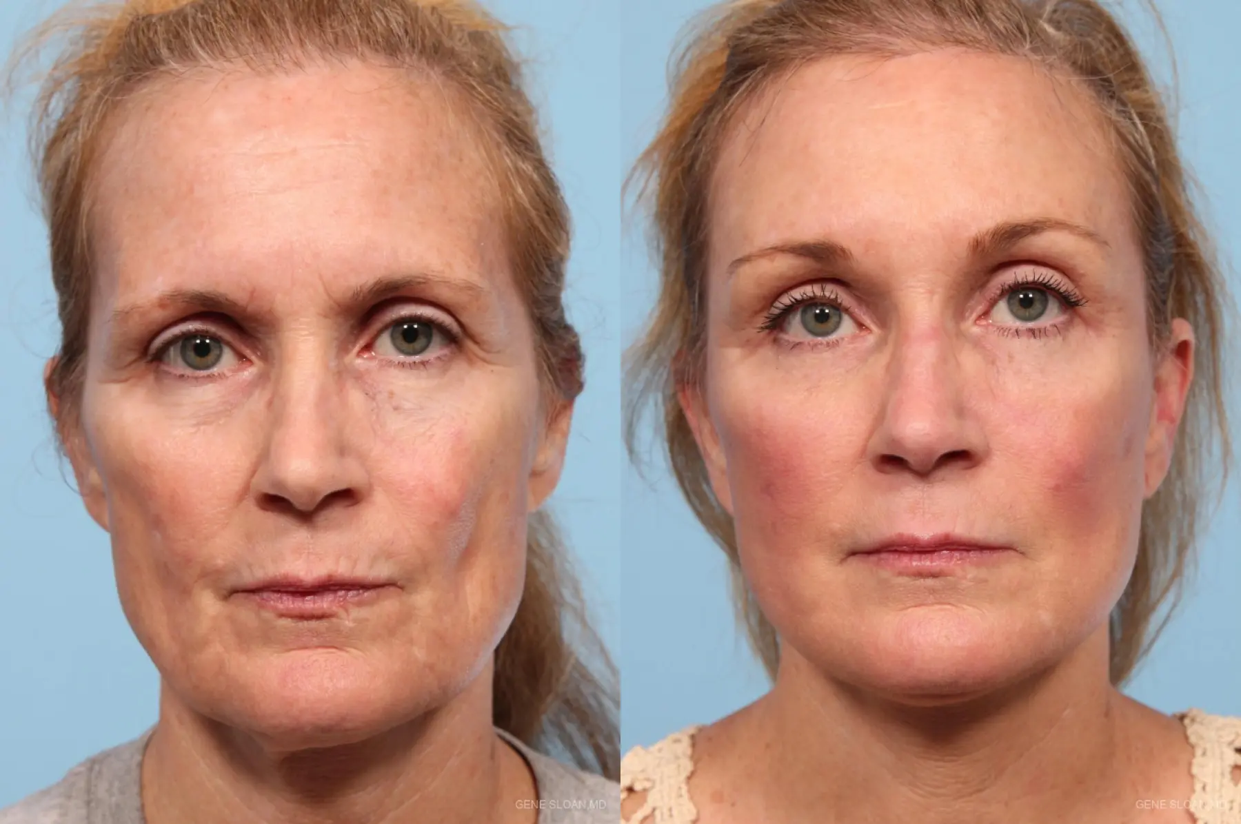 Facelift: Patient 7 - Before and After 1