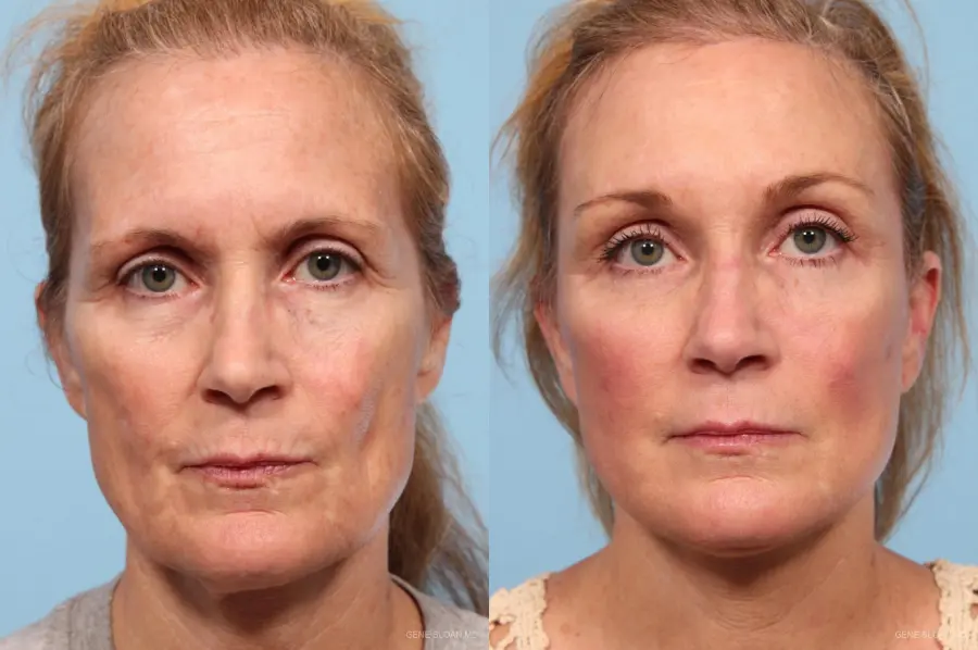Facelift: Patient 7 - Before and After