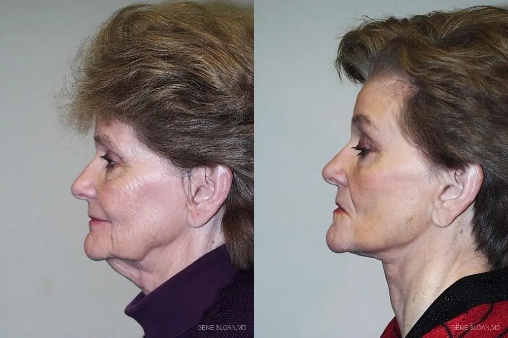 Facelift: Patient 3 - Before and After 2