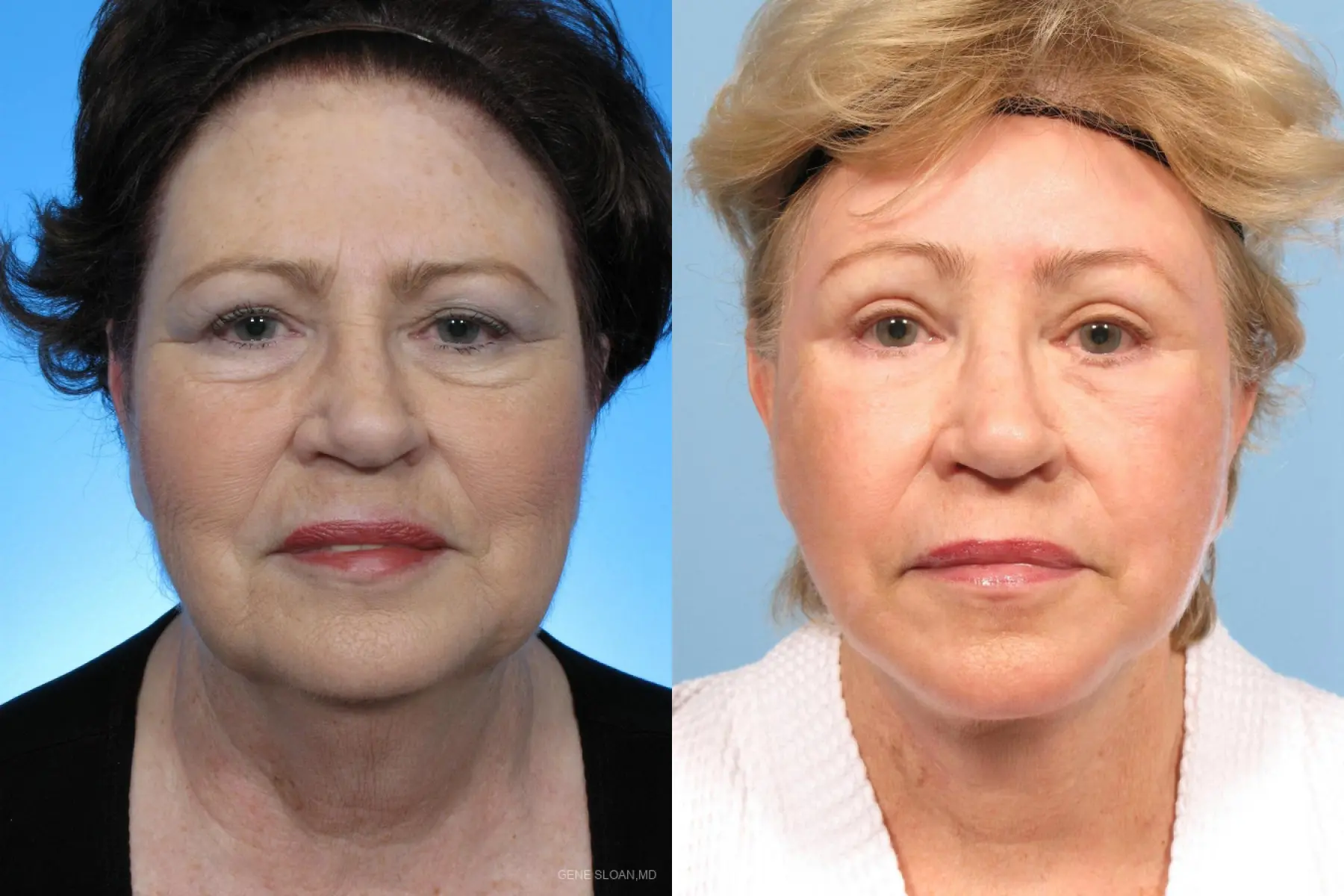 Facelift: Patient 1 - Before and After