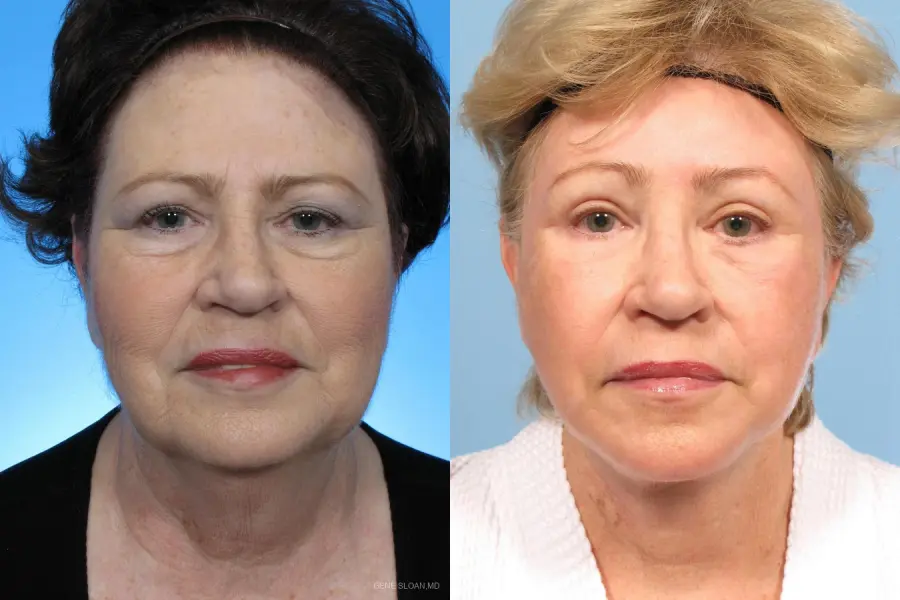 Facelift: Patient 1 - Before and After