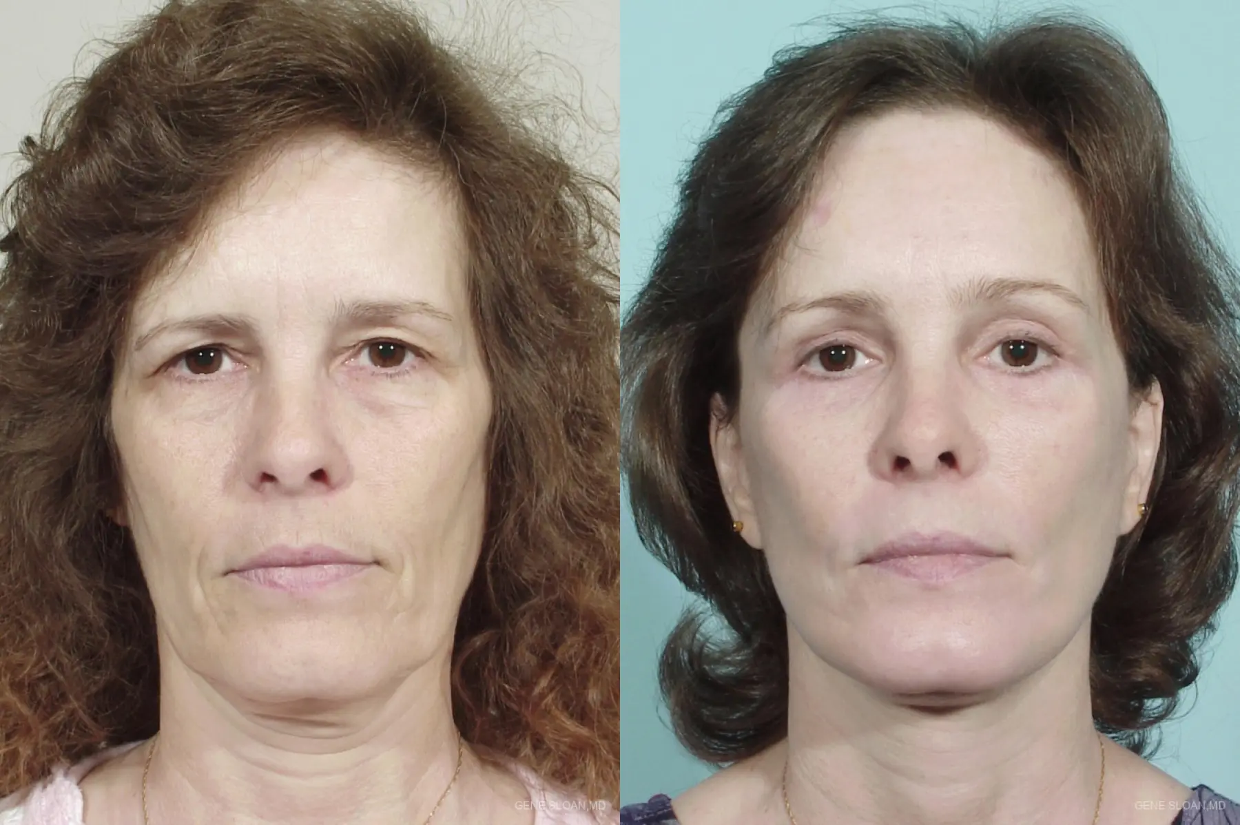Facelift: Patient 5 - Before and After