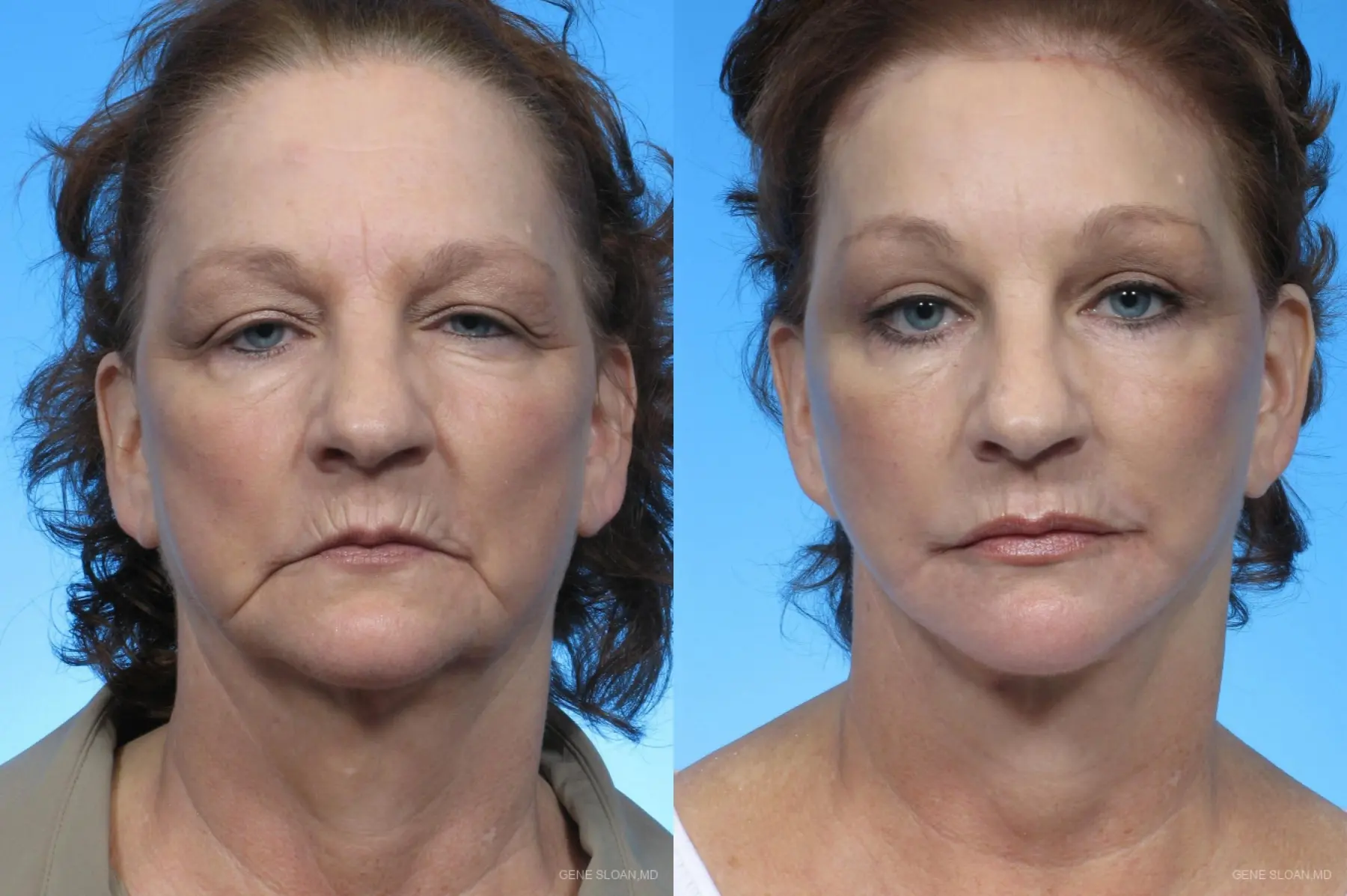 Facelift: Patient 2 - Before and After