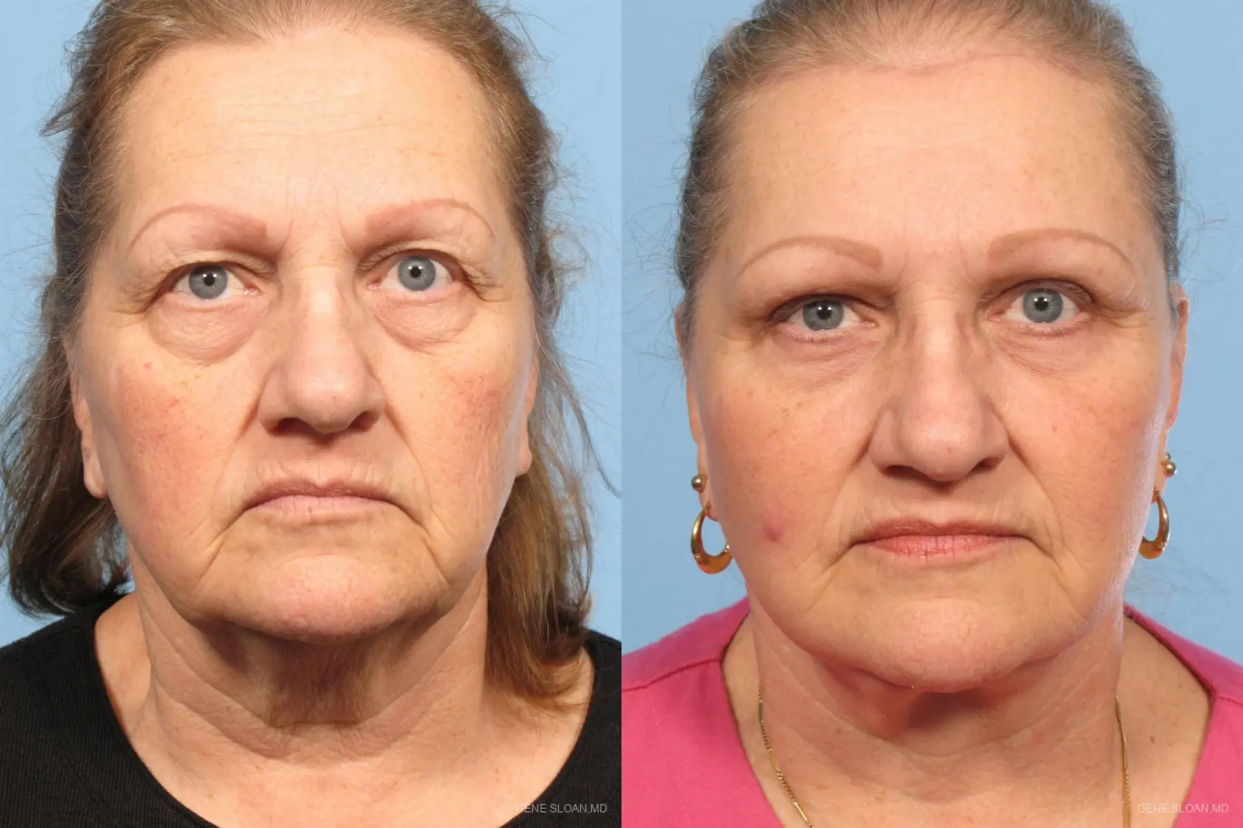 Facelift: Patient 6 - Before and After
