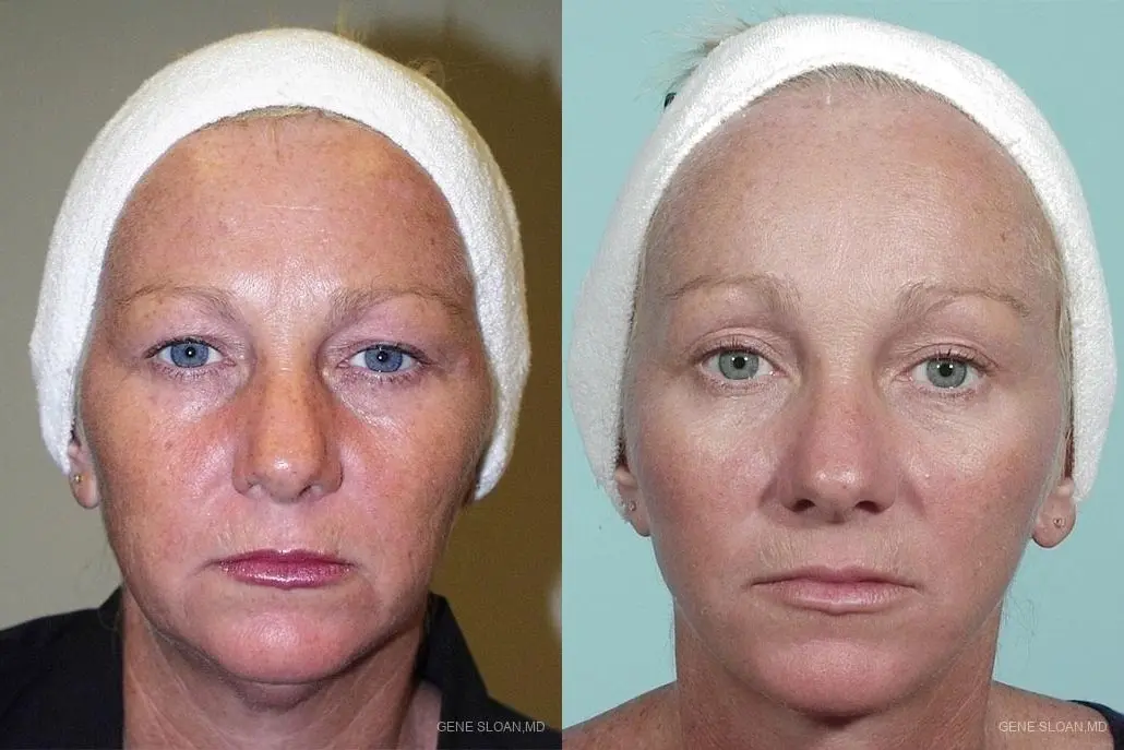 Facelift: Patient 4 - Before and After