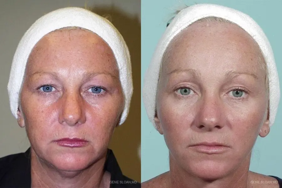 Facelift: Patient 4 - Before and After