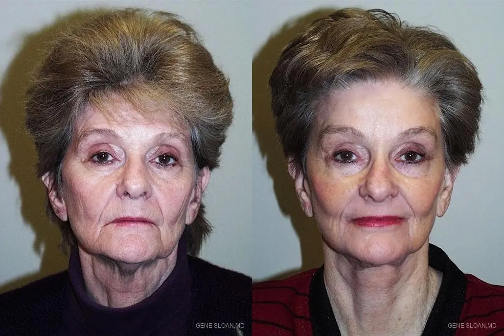 Facelift: Patient 3 - Before and After  