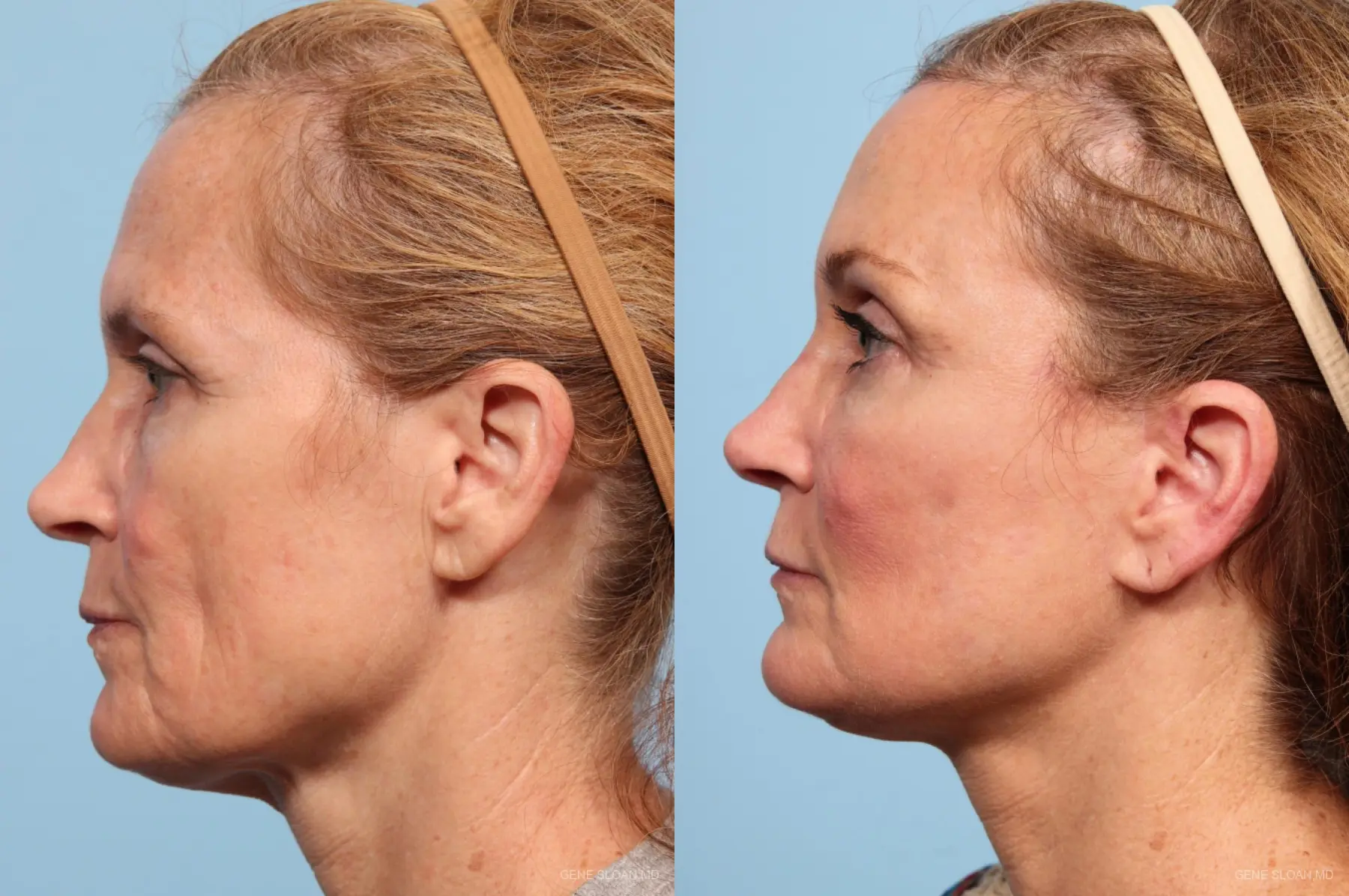 Facelift: Patient 7 - Before and After 3