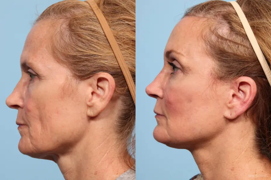Facelift: Patient 7 - Before and After 3