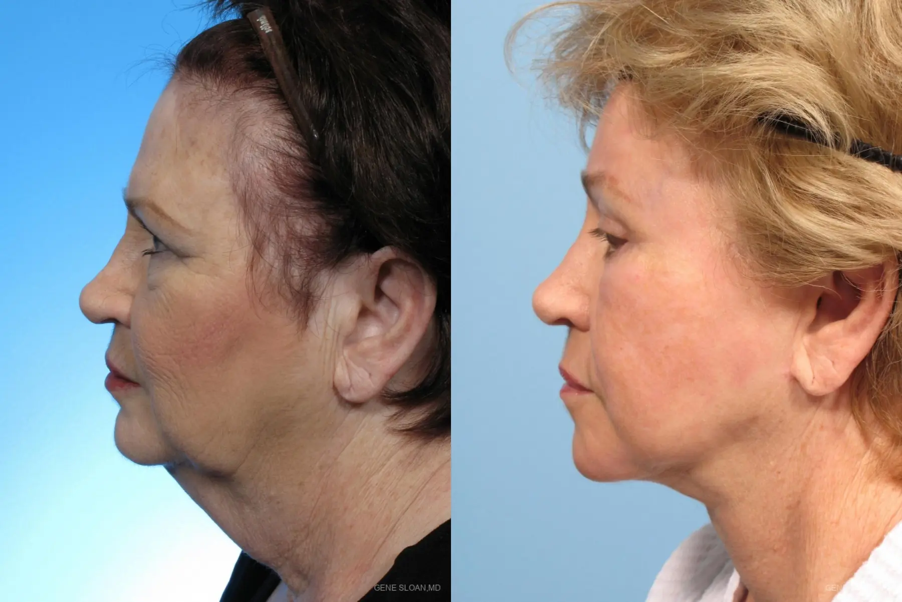 Facelift: Patient 1 - Before and After 2