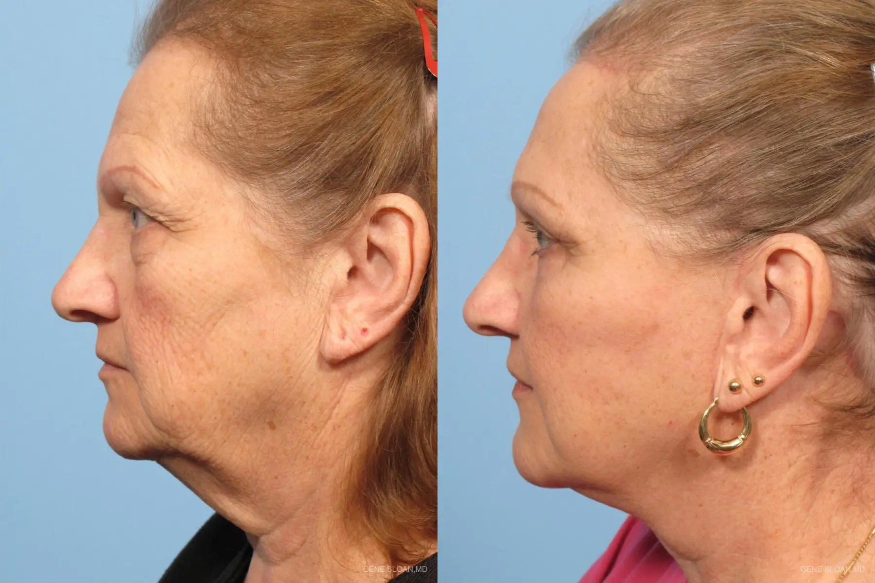 Facelift: Patient 6 - Before and After 2