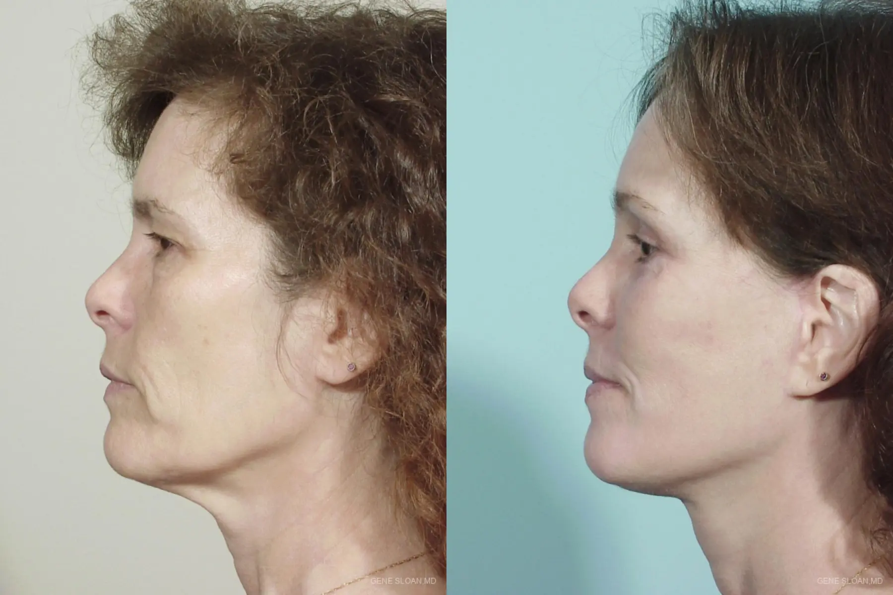 Facelift: Patient 5 - Before and After 2