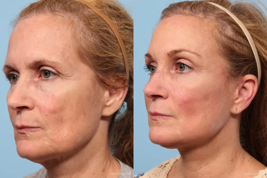 Facelift: Patient 7 - Before and After 2