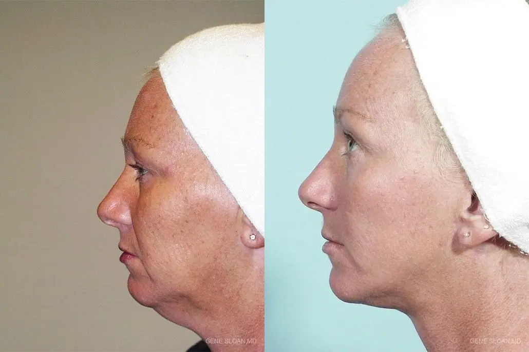 Facelift: Patient 4 - Before and After 2